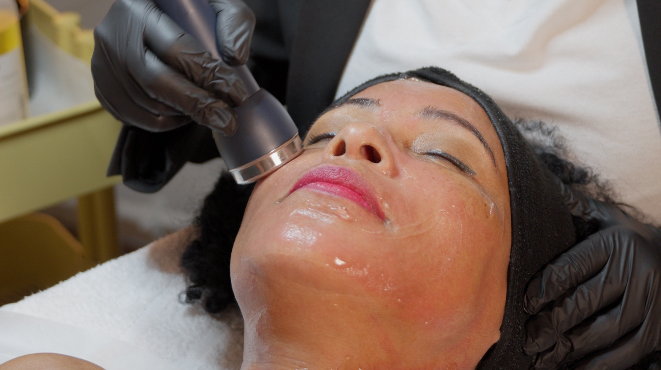 Fruchtsäure Peeling zur Hautbildverbesserung Nürnberg Nordstadt