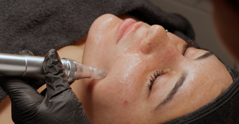 Microneedling mit Radiofrequenz bei Leila Santos in Nürnberg